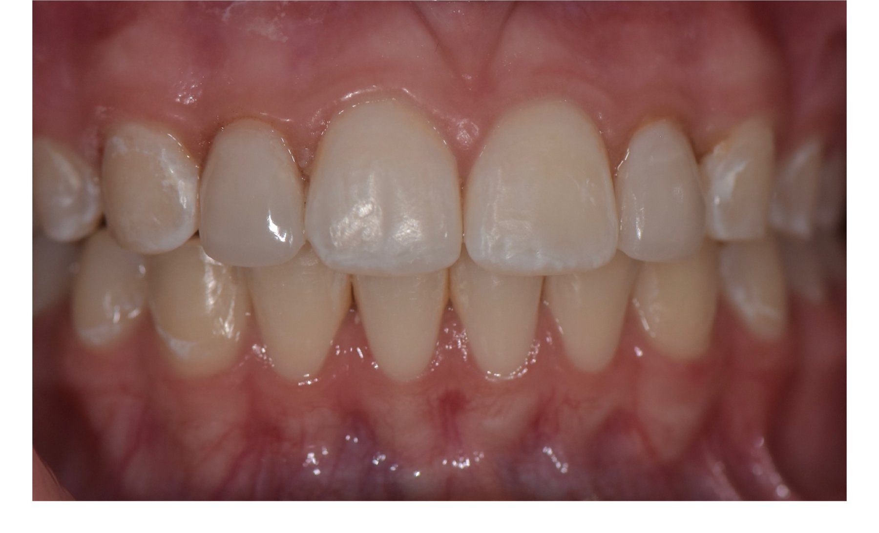 After: Close-up of a cosmetic bonding patient's front teeth showing even edges and length after treatment