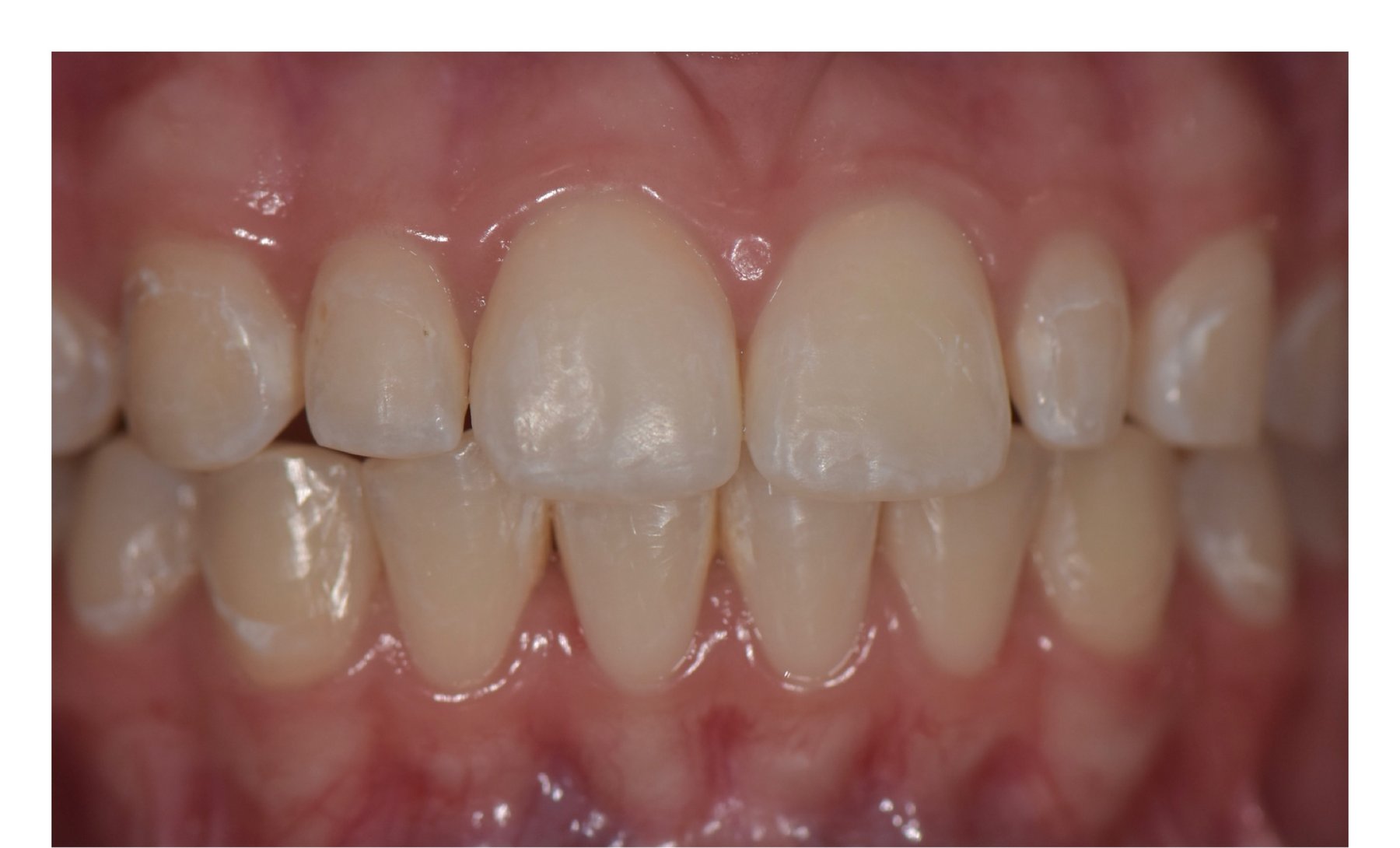 Before: Close-up of a cosmetic bonding patient's front teeth showing even edges and length after treatment