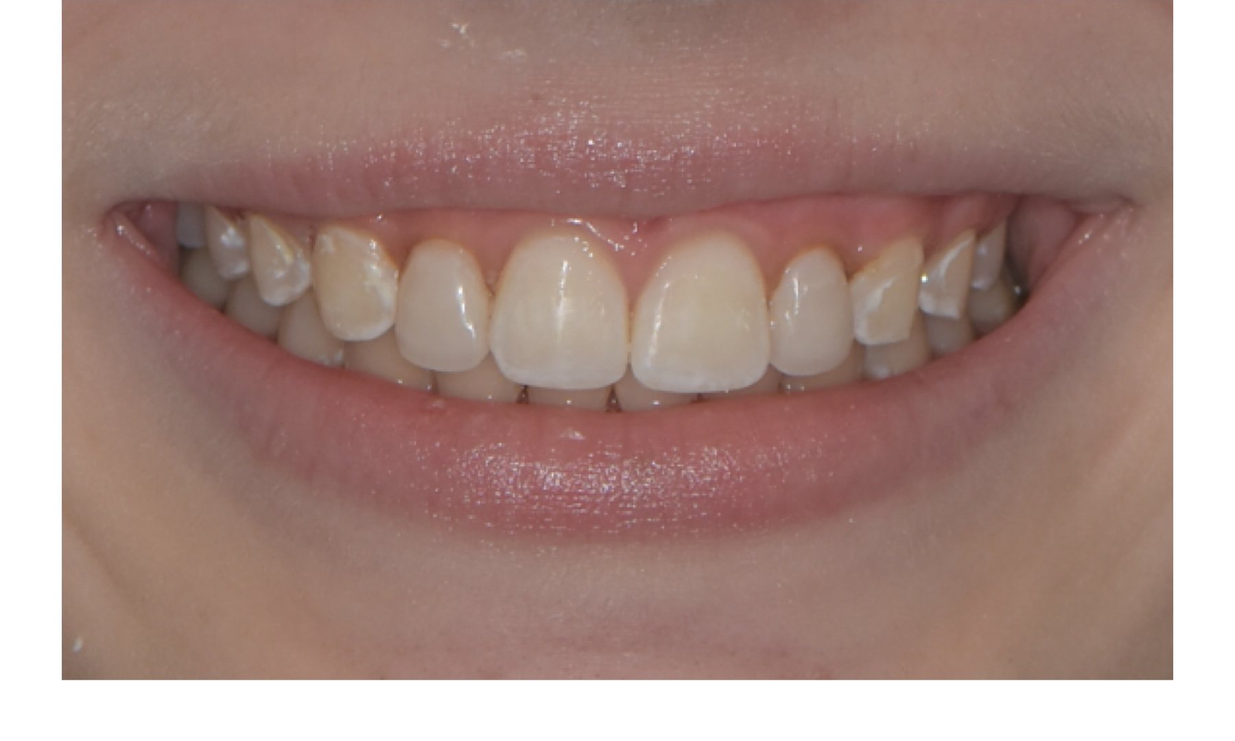 After: Cosmetic bonding patient in a smile-framed view before and after composite shaping