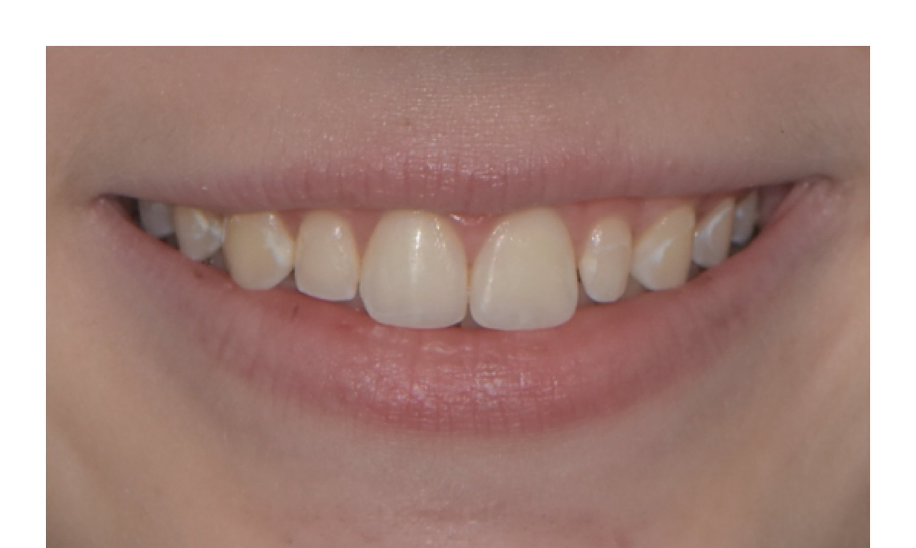 Before: Cosmetic bonding patient in a smile-framed view before and after composite shaping