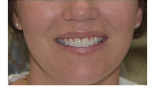 After: Smile makeover patient, full face view before and after combined cosmetic treatment