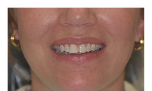 Before: Smile makeover patient, full face view before and after combined cosmetic treatment