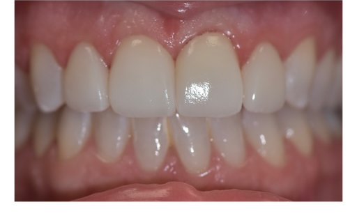After: Smile makeover patient, close-up view of front teeth before and after restoration