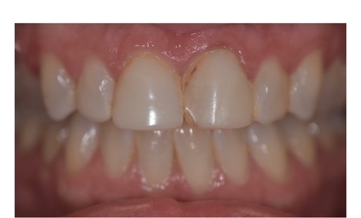 Before: Smile makeover patient, close-up view of front teeth before and after restoration