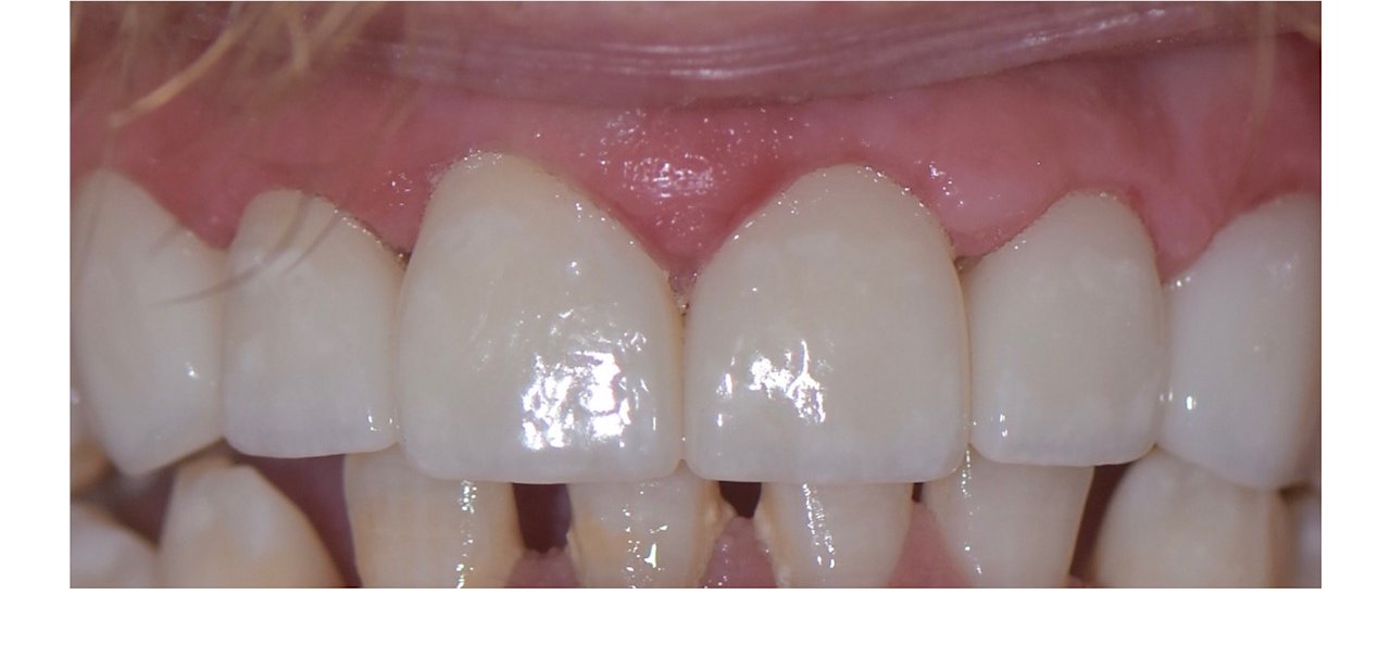 After: Smile makeover patient, close-up of severely worn enamel before treatment and the restored result after