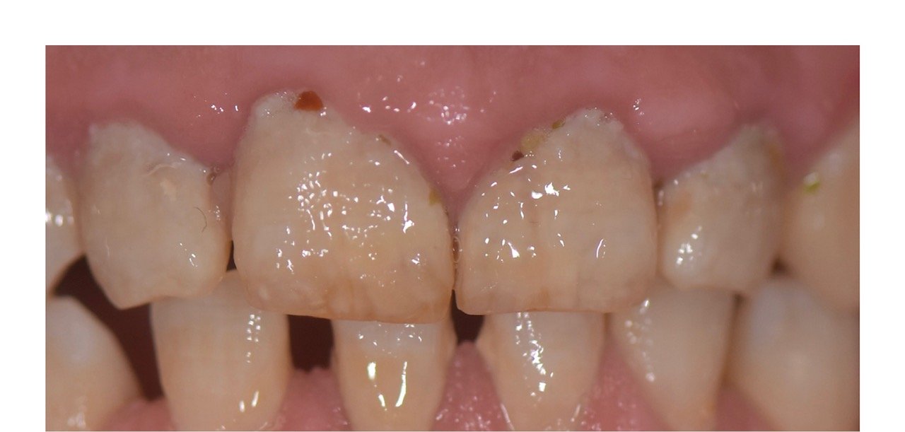Before: Smile makeover patient, close-up of severely worn enamel before treatment and the restored result after