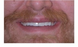 After: Smile makeover patient, discolored and uneven teeth before treatment and a bright, even smile after