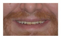 Before: Smile makeover patient, discolored and uneven teeth before treatment and a bright, even smile after