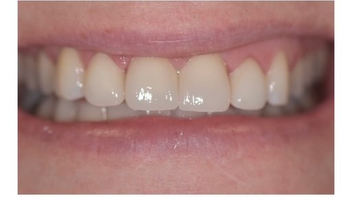 After: Patient smile before and after porcelain veneers, with corrected color, shape, and alignment