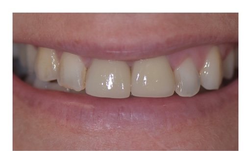 Before: Patient smile before and after porcelain veneers, with corrected color, shape, and alignment