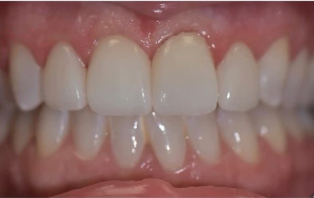 After: Close-up of front teeth before and after porcelain veneers, showing a chipped, worn tooth restored to an even, natural shape