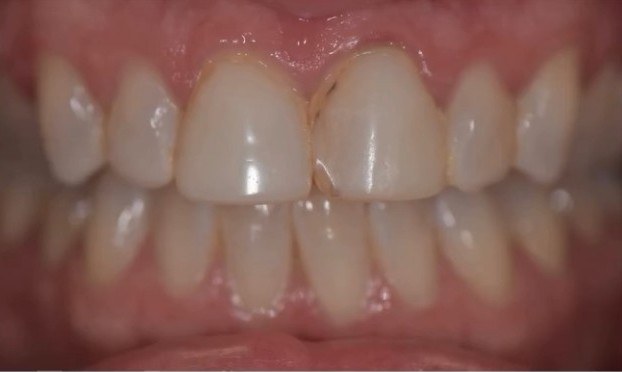 Before: Close-up of front teeth before and after porcelain veneers, showing a chipped, worn tooth restored to an even, natural shape