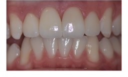 After: Close-up of front teeth before and after porcelain veneers, with a brighter, more even result