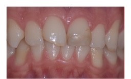 Before: Close-up of front teeth before and after porcelain veneers, with a brighter, more even result
