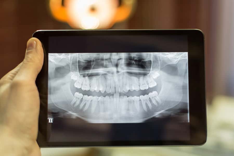Digital radiography equipment for low-radiation dental x-rays