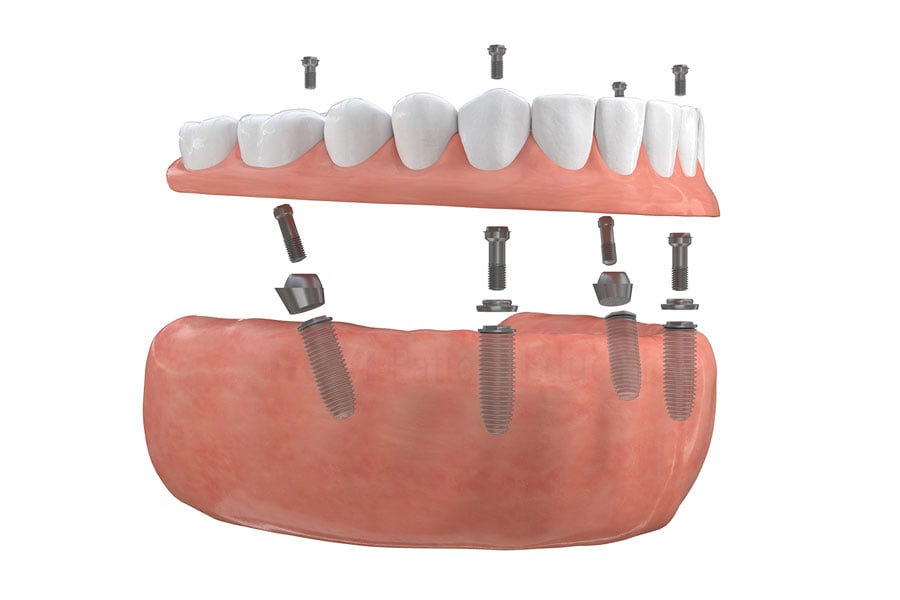 Full-arch implant-supported bridge at Aesthetic Dentistry