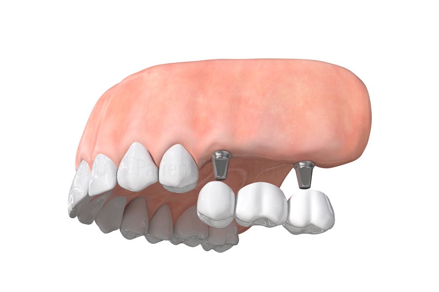 Implant-supported dental bridge at Aesthetic Dentistry