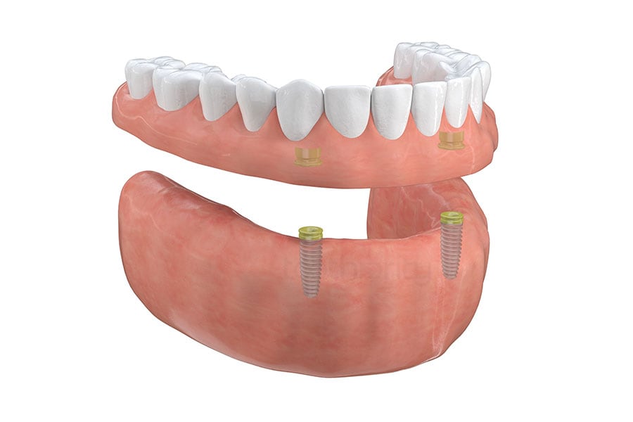 Implant-supported overdenture at Aesthetic Dentistry