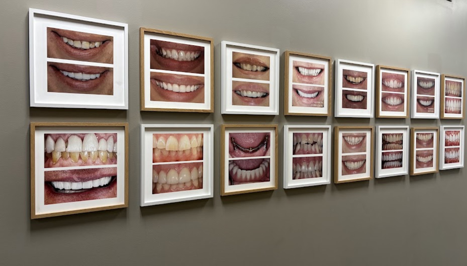 Smile gallery wall featuring before-and-after veneer cases