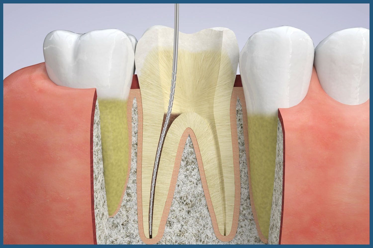 Stages of root canal therapy at Aesthetic Dentistry