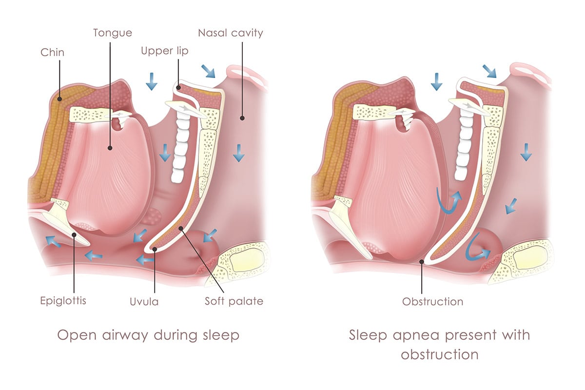 Sleep apnea treatment at Aesthetic Dentistry